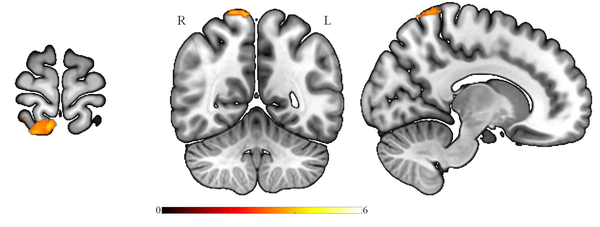 Survived significant brain regions after corrected for multiple comparisons, FWE correction, showed the amplitude of low-frequency fluctuation of paradoxical patients was less than healthy subjects at the superior parietal lobule and precuneus (MNIx, y, z: 8, -52, 74; cluster size: 156; PFWE < 0.001). FEW: Family wise error.