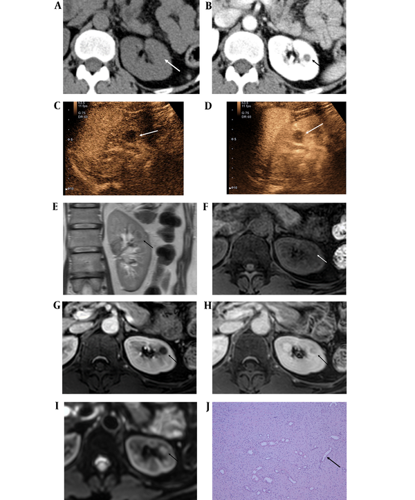 A 54-year-old female with hematuria, diagnosed with a renal interstitial cell tumor. A, Pre-contrast axial CT scan shows a 1-cm mass with iso-attenuation (white arrow); B, Enhanced axial CT scan shows a well-defined mass with dot-like enhancement in the central portion of the mass (black arrow); C, A 1-cm hypoechoic and hypovascular mass in the left kidney in the arterial phase of contrast-enhanced ultrasonography (CEUS) with Sonovue® (white arrow); D, The mass shows septal enhancement in the central portion in the venous phase of CEUS (white arrow); E, On coronal T2-weighted image, the mass shows a low signal intensity in the medullary portion of the left kidney (black arrow); F, The mass shows a low signal intensity on axial T1-weighted MRI (white arrow); G, In the axial portal phase image, the mass shows suspicious enhancement in the central portion of the mass (black arrow); H, In the 10-min delayed image, the mass shows persistent enhancement (black arrow); I, The mass shows mild diffusion restriction on the diffusion-weighted imaging/apparent diffusion coefficient (DWI/ADC) image (black arrow); J, The histopathological examination shows stellate and spindle cells in a background of fibrous stroma with entrapped renal tubules (black arrow) (hematoxylin & eosin staining, 100X magnification).
