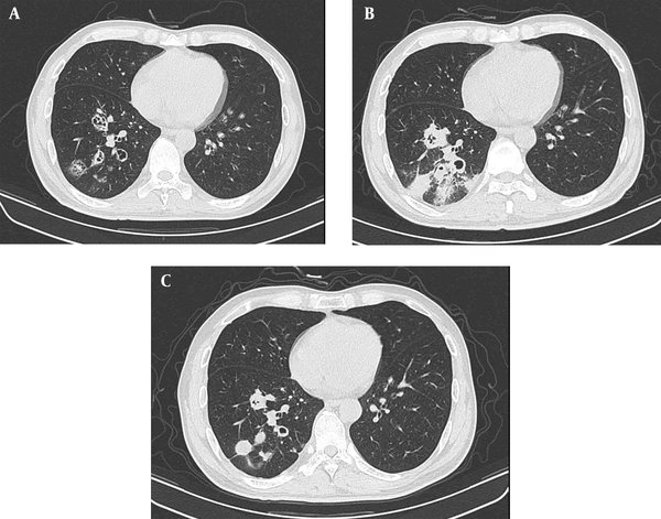 A-C, Pulmonary cryptococcosis (PC) in a 43-year-old man diagnosed with AIDS. CT scan (A) shows several cluster cavities in the right lower lobe, one of which is a cavity in wall (CW) lesion’, while others are thin-walled cavities with a CD4 cell count of 12/µL. Pulmonary lesions progressed to pneumonic infiltrates with ill-defined margins (B) two weeks after highly active antiretroviral therapy (HAART), with a CD4 cell count of 30/µL. In a review CT scan (C) after five months, cavities and consolidation had become solid nodules with clear borders with the normal lung, and the CD4 cell count in peripheral blood increased to 158/µL.