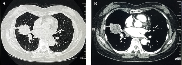 A 61-year-old female patient with a body mass index (BMI) of 24.3 kg/m2. Enhanced chest CT scan (100 kVp, 270 mgI/mL of contrast agent, 40% ASIR) scored five points in the subjective evaluation of image quality. A, Lung window: The lesions showed lumpiness and high density with rough edges and multiple short burrs; B, Mediastinal window: Heterogeneous enhancement (ASIR, adaptive statistical iterative reconstruction).
