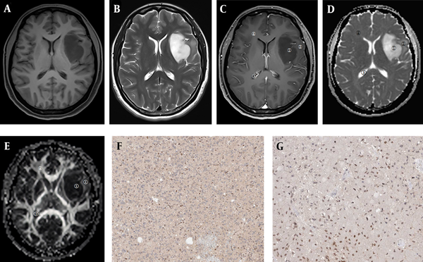 Images of a 40-year-old female patient with the WHO grade II left temporal lobe astrocytoma. A, T1WI tumor lesion area shows low signal intensity; B, T2WI tumor lesion area shows high signal intensity; C, Contrast-enhanced image shows no obvious enhancement; D, In the ADC map, both tumor parenchymal area and peritumoral edema area show high signal intensities; E, In the FA map, the tumor parenchymal area shows an uneven low signal intensity pattern, and the peritumoral edema area shows an uneven and slightly high signal intensity pattern (ROI 1, tumor parenchymal area; ROI 2, peritumoral edema area; ROI 3, cerebrospinal fluid area; ROI 4, contralateral normal white matter area; F, positive VEGF expression; H, positive Ki-67 expression).