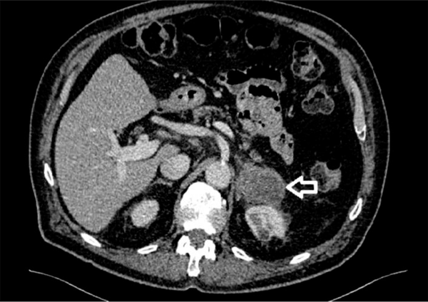 Follow-up computerized tomography of abdomen showing the left adrenal gland tumor measuring 52 × 41 mm and invading the left renal vein and the capsule of the anterior aspect of the left kidney