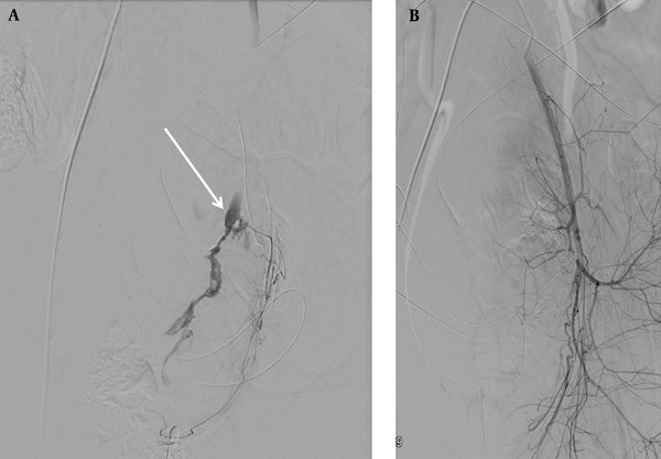 Angiograms of a 32-year-old woman with primary postpartum hemorrhage (PPH) after cesarean section (CS). A, Digital subtraction angiogram (DSA) of the left uterine artery. Contrast extravasation is indicated by an arrow; B, DSA after embolization of the left uterine artery. Hemostasis is achieved after superselective coil embolization of the left uterine artery.