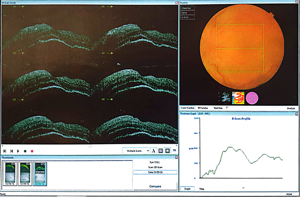 The ocular coherence tomography (OCT) image of the left eye has an irregularity in the thickness of the retina, and in the temporal side of the area, increased thickness can be seen along with the hypo area.
