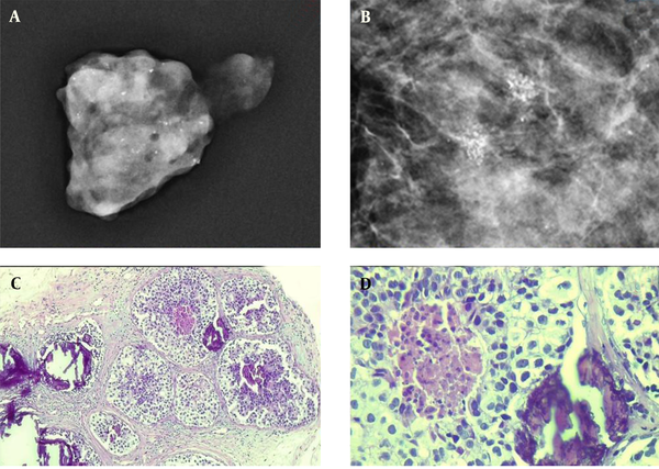 A sample of detected microcalcifications in a patient with ductal carcinoma in situ (DCIS). The detected lesions in the mammogram indicate a fine pleomorphic microcalcification (A & B). The pathological examination of the microcalcification is presented at low (C) and high (D) powers of microscopic evaluation.
