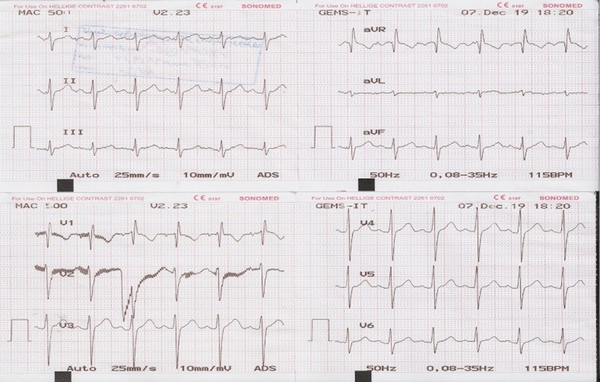 The ECG during the resting phase