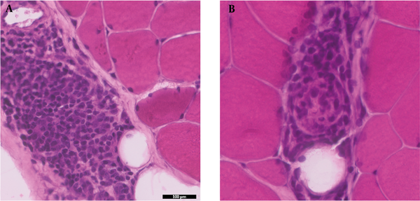 A and B, Hematoxylin and Eosin (H&E) sections show focal perimysial and perivascular non-granulomatous inflammation in a background of non-necrotizing muscle fibers (magnification 40X).