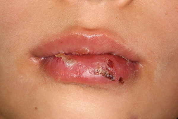 Clinical appearance of the lip laceration with embded fragments