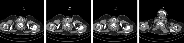 Axial CT images from the larynx showing severe closure of vocal cords causing airway stenosis