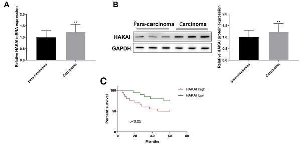 HAKAI is highly expressed in bladder cancer and associated with poor prognosis; A, qRT-PCR; and B, western blot were used to detect the expression of HAKAI mRNA and protein in bladder cancer; C, Kaplan-Meier survival analysis was used to analyze the relationship between HAKAI expression and patient survival. Paired t-test was used for the two-group comparisons. ** P &lt; 0.01, carcinoma group vs. para-carcinoma group.