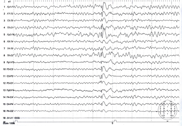 Electroencephalogram of a 30-year-old man with tramadol-induced seizures showing generalized sharp-slow waves