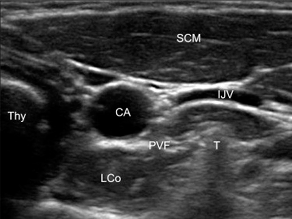 Ultrasound view of stellate ganglion (SCM, sternocleidomastoid; LCo, lungoscolli; PVF, prevertebral fascia; T, C6 tubercle; CA, carotid artery).