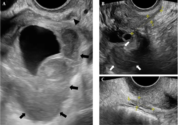 A, Transvaginal sonography (TVS) presents a sizable right-sided ovarian endometrioma (OE) with a thick echogenic wall and low-level internal echogenicity (arrows) along with an adjacent ipsilateral uterosacral ligament deeply infiltrating endometriosis (DIE) plaque (arrowhead). The DIE plaque has an angulated and irregular margin. B and C, TVS demonstrates an endometrioma (arrows) with adjacent irregular, amorphous, elongated, and hypoechoic foci of DIE deposition between clipper