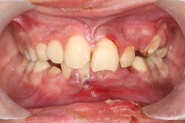 Initial intraoral view showing the coronal fractures and extrusive luxations of the central incisors and gingival laceration of anterior segment of mandible.