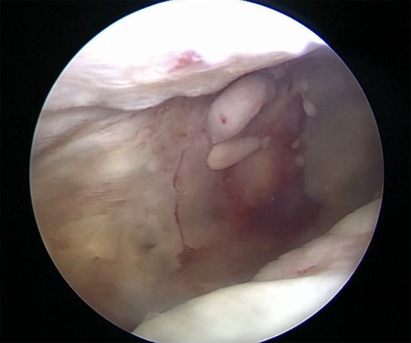 Detachment of the tendinous part of the SSC insertion from the humerus (type 3 tear)