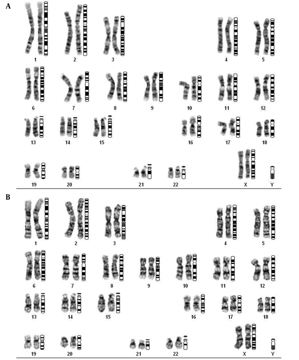 Sample karyotype related to the participants in the study. A, shows the karyotype of a person with chronic myeloid leukemia with translocation 9:22; B, shows the karyotype of a normal person without translocation.