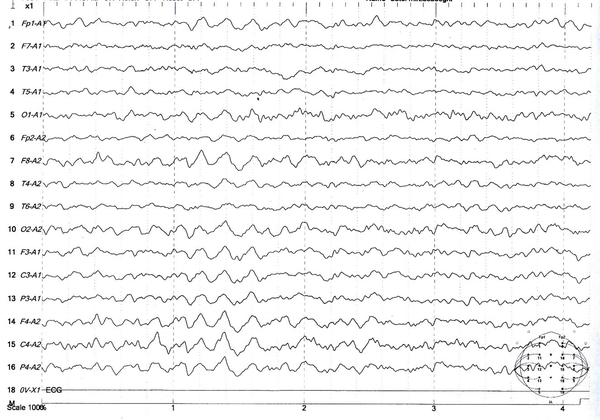 Electroencephalogram of a 37-year-old man with seizures caused by tramadol consumption showing diffuse slowness