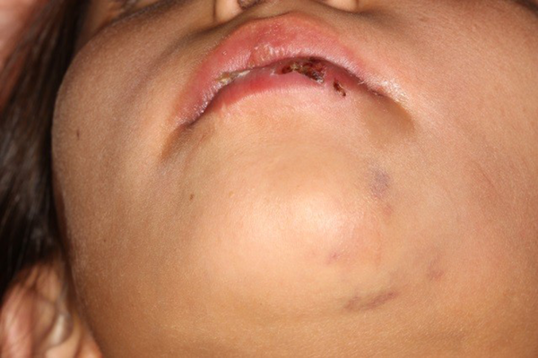 Clinical appearance after the chin trauma