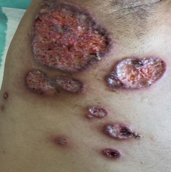 Large necrotic ulcer