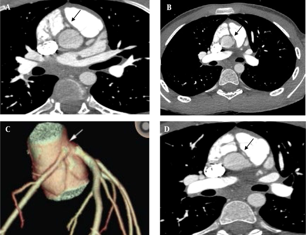 Computed tomographic coronary angiography image with an anomalous right coronary artery (RCA) from the opposite sinus (A, B, C); three -dimensional reconstruction of coronary artery shows the course of RCA in relation to the left main and left anterior descending arteries (arrow) (D). Computed tomographic coronary angiography image with an anomalous right coronary artery (RCA) from the opposite sinus (A, B, C); three -dimensional reconstruction of coronary artery shows the course of RCA in relation to the left main and left anterior descending arteries (arrow) (D).