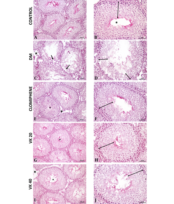 A and B, Normal seminiferous tubule morphology (*) and normal germinal cell layers in the seminiferous tubule epithelium in the control group; C and D, Vacuolization in the seminiferous tubules (ïƒ) and a decrease in the number of germinal epithelial layers in the seminiferous tubules in the diabetes mellitus (DM) group; E and F, In the clomiphene group, morphology was similar to the control group in the seminiferous tubules (*) and normal germinal cell layers in the seminiferous tubule epithelium. Decreased openings in the interstitial area; G and H, Normal seminiferous tubule morphology (*) and normal germinal cell layers in the seminiferous tubule epithelium; I and J, Seminiferous tubule morphology (*) was similar to the control group and near-normal organization in the number of germinal epithelial layers (A, C, E, G, I: 20X; B, D, F, H, J: 40X).