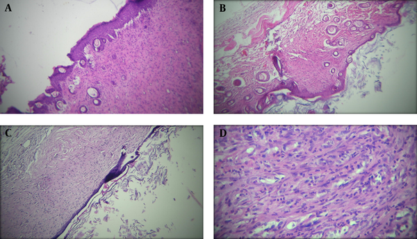 Histopathological presentation (100x) of mice’s second-degree burned skin in treatment groups after 21 days treatment; A, The appearance of a skin sample in Althaea officinalis aqueous extract 4% group, mild angiogenesis, thick epidermis, and a small number of polymorphonuclears (PMNs); B, in A. officinalis hydroalcoholic extract 4% group, low angiogenesis, thick epidermis, and low inflammatory cells; C and D, in the control group, thin epidermis, mild angiogenesis, and many PMNs