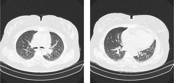 Axial images of the lung showing no evident opacities