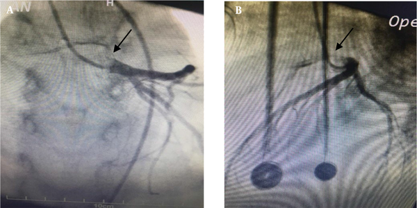 Selective left coronary artery angiography shows right coronary artery from left sinus and slit-like coronary compressed between the pulmonary artery and aorta (A, B).