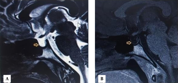 MRI Brain - Yellow arrow showing empty sella (A) T2 weighted, (B) T1 weighted.