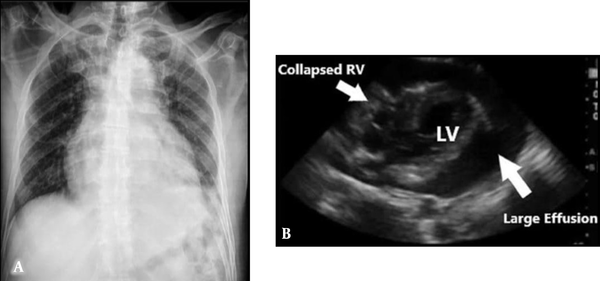 (A) Chest X-ray (Left side): Increased cardiac silhouette, (B) 2D Echo (right side): Large pericardial effusion with collapsed RV.