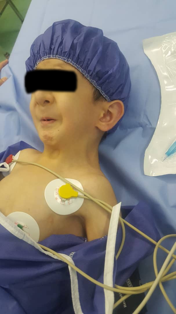 A four-year-old female with Schwartz-Jampel syndrome and epilepsy