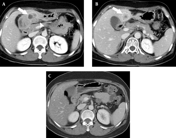 A 49-year-old woman with an inflammatory myofibroblastic tumor in the gastric antrum. A, Contrast-enhanced computed tomography (CT) scan showing a heterogeneous enhancing mass (arrow) in the thickened wall of the gastric antrum. Perigastric infiltration (arrowhead) extends to the gastrohepatic ligament; B, A targetoid enhancing mass lesion (arrow) is seen in the liver. Perigastic infiltration extends to the gastrohepatic ligament; and C, Contrast-enhanced CT scan taken 11 months after medical treatment shows complete remission of both tumor lesions.