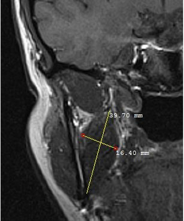 Measurements of the height and width of the medial pterygoid muscle in the coronal T1W sequence