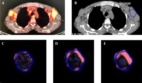 A, Baseline 18FDG PET/CT scan of a target lymph node lesion (arrow); B, Unenhanced CT scan of 18FDG PET/CT study with delineated regions of interest (ROIs). The images display the texture of the lesion: C, fine SSF = 2; D, medium SSF = 4; and E, coarse SSF = 6 (SSF = spatial scale filter).
