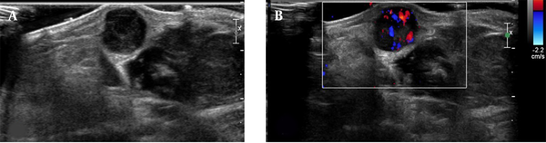 Transverse ultrasonography (A), and color Doppler (B), images show a hypoechoic solid mass in the subcutaneous fat layer with intralesional hypervascularity.