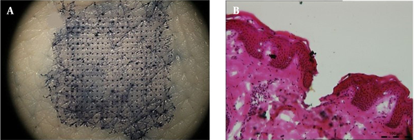 Skin insertion ability of GEST-loaded DMNs. (A) Array of drug-loaded DMN holes in porcine skin stained with TB after insertion. (B) Histological section of drug-loaded DMNs-treated porcine skin.