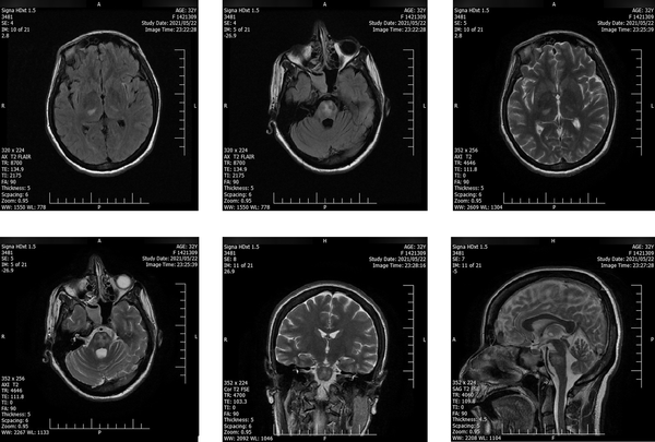 Magnetic resonance imaging two days after discharge showed a slight decrease in signal hyper-intensity in the bilateral symmetric areas of the thalamus, cerebral peduncles, and brainstem.
