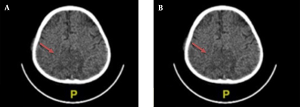 Head computed tomography (CT) scan with contrast. A, cerebral infarction; B, hypodense lesion predominant on the left basal ganglia