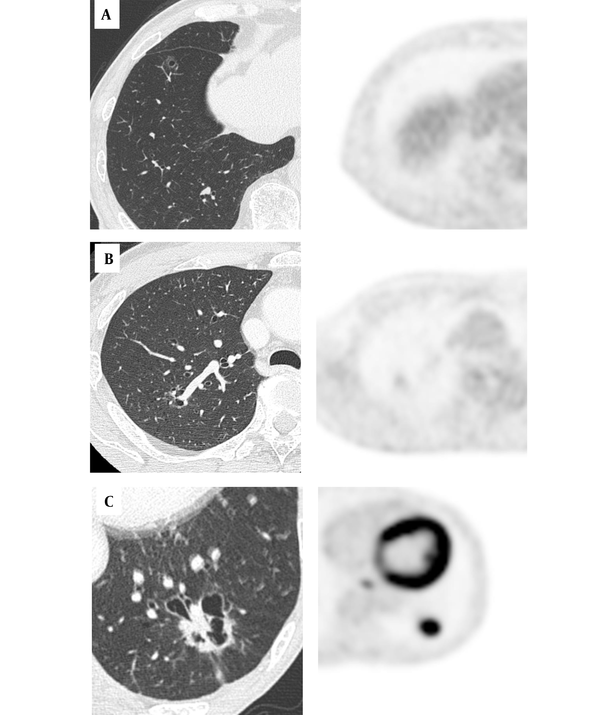 The CT scans and corresponding fluorodeoxyglucose positron emission tomography (FDG-PET) images of cystic and cavitary lung cancer (CCLC). Top row: A, An 80-year-old man with minimally invasive adenocarcinoma (AD); the FDG-PET scan shows absent uptake (maximum standardized uptake value (SUVmax) = 0). Middle row: B, A 60-year-old man with invasive AD; the FDG-PET scan shows moderate uptake (SUVmax = 1.24). Bottom row: C, A 68-year-old woman with squamous cell carcinoma (SCC); the FDG-PET scan shows marked uptake (SUVmax = 8.61).