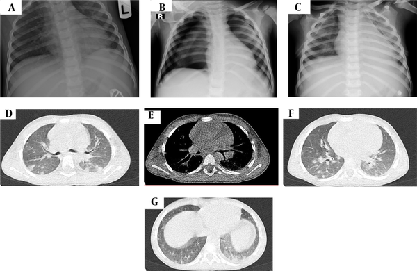 [Top row] Sequential plain posteroanterior (PA) chest X-ray (CXR) images taken on different days of hospital stay. (A) On admission, PA CXR shows mild diffuse pulmonary infiltration and ground-glass opacities accompanied by faint air bronchograms in both lung fields; (B) PA CXR on the fifth day of admission reveals mild left-sided, and moderate right-sided parenchymal lung collapses associated with bilateral air bronchograms, and visible pleural lines consistent with moderate right-sided pneumothorax and mild left-sided pneumothorax; (C) AP CXR after bilateral chest tube insertion on the same day. Chest tubes are properly placed in pleural spaces. Well-expanded lungs with no residual pneumothorax are noted. [Middle and down rows] Spiral chest CT scan cuts in the axial plane, lung window, at different levels of lungs on the first day of admission. (D &amp; E) Below the level of the carina, diffuse subpleural ground-glass densities associated with multiple peripherally located (dominantly subpleural and posterior) pulmonary nodules with peripheral halos are seen in both lung fields. Also, several bilateral reactive hilar lymph nodes are noted on the mediastinal window; (F) At the level of the left ventricle, multiple areas of ground-glass densities associated with peripherally and centrally located pulmonary nodules demonstrating peripheral halos are observed in posterior aspects of the lung fields. Mild left-sided pleural effusion is also noted; (G) At the diaphragm level, multiple areas of subpleural ground-glass densities associated with few pulmonary nodules are seen in the bases of the lungs, prominent on the left. Mild left-sided pleural effusion is demonstrated.