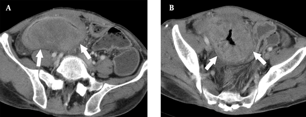 A 52-year-old man with a loosely arranged inflammatory myofibroblastic tumor in the ileum. A, Contrast-enhanced computed tomography (CT) scan showing a low-density mass with unclear margins (arrows) and low-density wall thickening around it; B, There is very severe wall thickening (arrows), as well as peripheral infiltration, but no bowel obstruction.