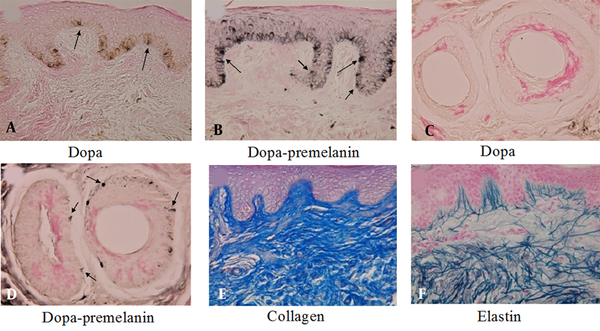 A, B, Histochemical sections of the thumb’s skin derived from a 53-year-old woman. A, The dopa reaction revealed many melanocytes (arrows) with dendrites in the basal layer of the epidermis; and B, The combined dopa-premelanin reaction revealed melanocytes and melanoblasts; C, D, Melanoblasts (short arrows) are lightly stained, while melanocytes (long arrows) are darkly stained. Histochemical sections of the face skin of a 9-year-old boy; C, There is no dopa-positive melanocyte in the outer root sheath of hair follicles; D, By contrast, the combined dopa-premelanin reaction revealed many melanoblasts (arrows) in the outer root sheath of hair follicles; In the dermis of the buttocks of a 20-year-old lady, well-developed E, collagen; and F, elastin fibers are observed. Some of the elastin fibers penetrated the basement membrane of the epidermis. Magnification × 400