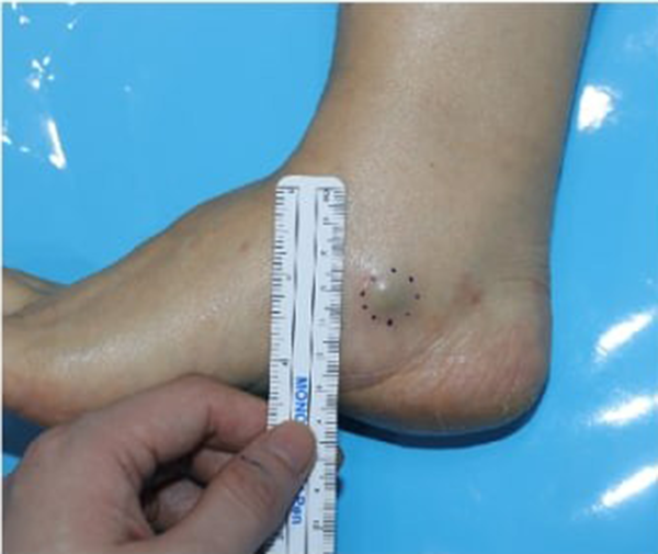 A 64-year-old female with a history of painful palpable mass for three years in her right ankle. In gross examination, the lesion shows a bluish colored protruding mass on the medial ankle.