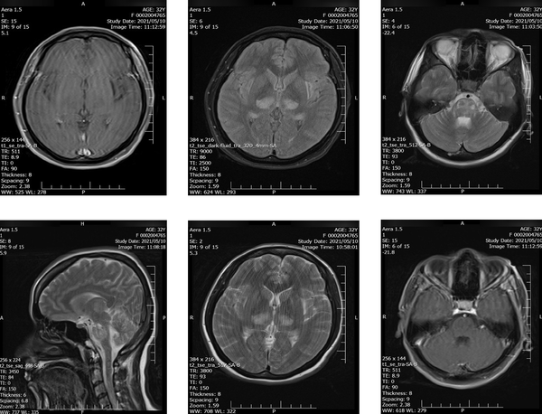 T2-weighted-fluid-attenuated inversion recovery (T2-FLAIR) magnetic resonance imaging (MRI) on day one showed hyper-intensity in the bilateral symmetric areas of the thalamus, cerebral peduncles, and brainstem.