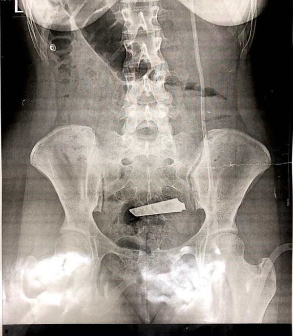 Abdominal X-ray showing knife blade at lower GI tract raptured sigmoid and ovary