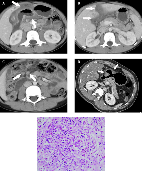 A 17-year-old man with an inflammatory myofibroblastic tumor in the gastric antrum. A, Contrast-enhanced computed tomography (CT) scan showing low-attenuating wall thickening (arrows) in the gastric antrum with severe perigastric infiltration. There is mucosal disruption, indicating the presence of a large mucosal ulcer; B, Perigastric infiltration (arrows) extends to the hepatoduodenal ligament and falciform ligament; C, Multiple enlarged lymph nodes (arrows) are seen along the greater curvature side of the gastric antrum; D, Contrast-enhanced CT taken 14 years after medical treatment shows remnant wall thickening in the gastric antrum with a bulging appearance (arrows), besides the improved state of perigastric infiltration; and E, The photomicrograph (Hematoxylin and Eosin [H&E] staining, 400X staining) shows loosely arranged spindle-shaped tumor cells with abundant blood vessels and an infiltrate of inflammatory cells, including plasma cells and eosinophils.