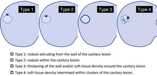 Morphological patterns of cystic and cavitary lesions. The image shows the morphological patterns of cystic and cavitary lung cancer (CCLC), classified into four types as proposed by Mascalchi et al. (type 1, nodule extruding the wall of cavitary lesion; type 2, nodule within the cavitary lesion; type 3, thickening of the wall and/or soft tissue density around the cavitary lesion; and type 4, a soft-tissue-density structure intermixed within clusters of cavitary lesion).
