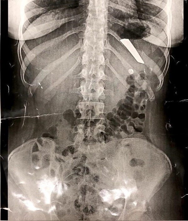 Abdominal X-ray showing a knife blade in the patient's stomach