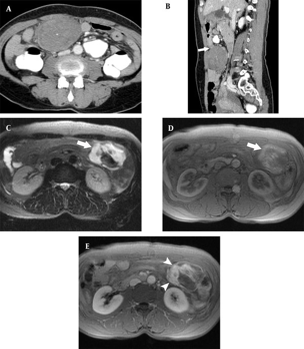 A 55-year-old woman with a compactly arranged inflammatory myofibroblastic tumor in the gastric antrum. A, A well-defined low-density mass is seen in the greater curvature side of the gastric antrum; B, The mass shows an exophytic pedunculated appearance (arrow) at the gastric antrum; C, Fat-saturated T2-weighted MR image shows T2 signal hyperintensity (arrow) in the mass; D, Pre-contrast T1-weighted image shows high signal intensity (arrow) in the mass, representing hemorrhage; and E, Contrast-enhanced T1-weighted image shows that the part of the mass with high signal intensity in the T1-weighted image becomes contrast-enhanced (arrowheads), representing the myxoid component.