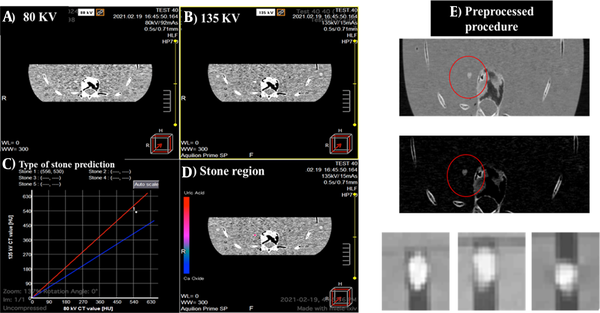 A, Phantom images acquired by 80-kV X-ray; B, 135-kV X-ray; C, Stone type determination using the scanner software algorithm; D, Stone region; and E, Preprocessing for creating the stone dataset in deep networks